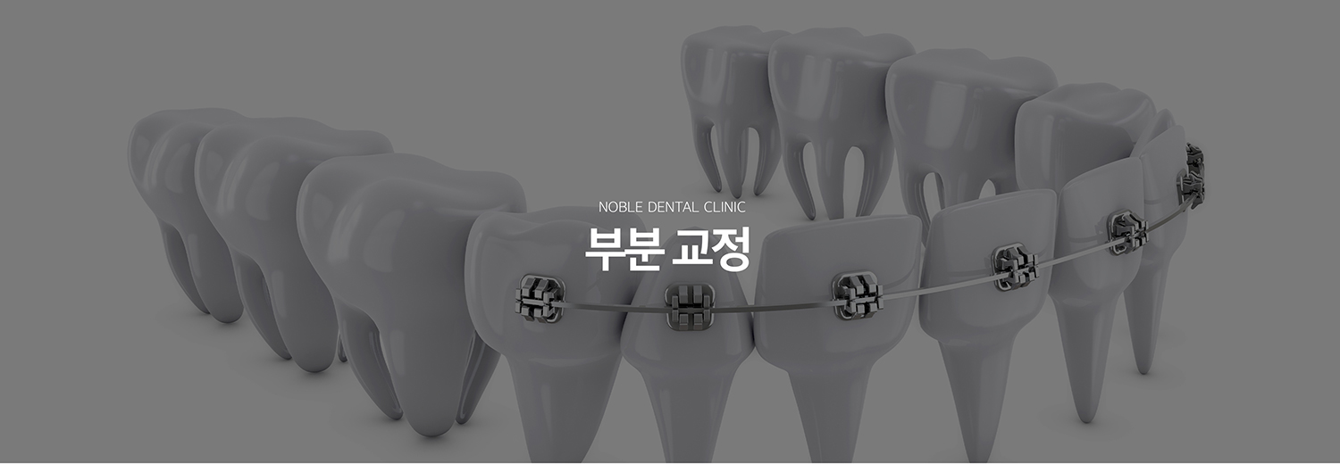 수원 부분교정 대표 안내 - 부분교정은 전체 치열이 아니라 특정 치아나 제한된 구간의 배열과 공간을 조정하는 치료입니다. 치료 범위가 작아 보여도 전체 교합에 미치는 영향을 확인해야 하므로 부분교정이 적합한지 먼저 진단하는 과정이 중요합니다.