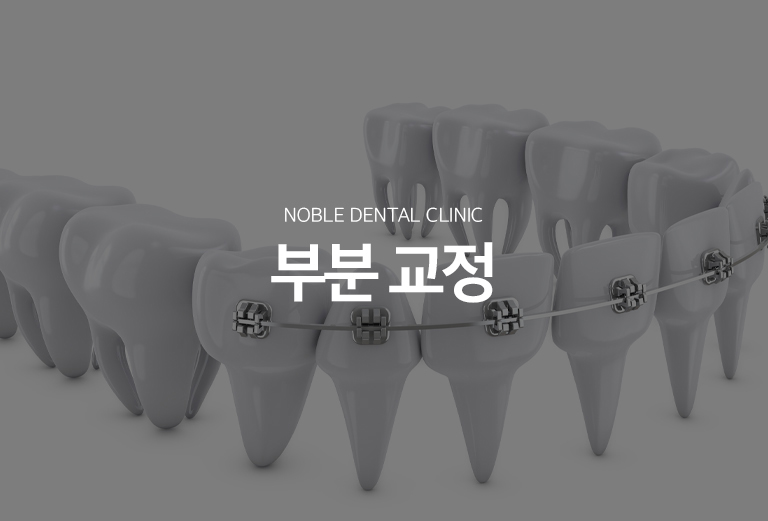 수원 부분교정 대표 안내 - 부분교정은 전체 치열이 아니라 특정 치아나 제한된 구간의 배열과 공간을 조정하는 치료입니다. 치료 범위가 작아 보여도 전체 교합에 미치는 영향을 확인해야 하므로 부분교정이 적합한지 먼저 진단하는 과정이 중요합니다.