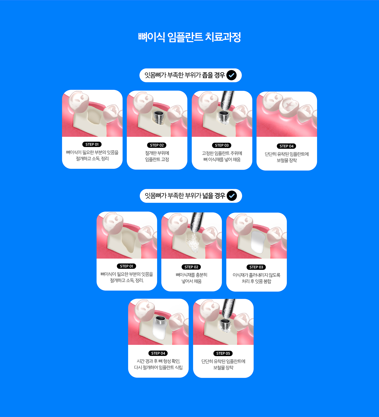 수원 뼈이식 임플란트 상세 안내 - 동시 뼈이식과 단계적 뼈이식 - 결손이 제한적이고 임플란트 초기 고정을 확보할 수 있으면 식립과 뼈이식을 함께 고려할 수 있습니다. 결손이 크거나 조직 상태가 불리하면 뼈이식 후 치유기간을 두고 임플란트를 진행할 수 있습니다.