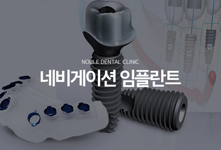 수원 네비게이션 임플란트 대표 안내 - 네비게이션 임플란트는 3D 영상 자료와 구강 정보를 바탕으로 임플란트 위치와 방향을 사전에 계획하고, 필요한 경우 수술 가이드를 활용하는 방식입니다. 가이드 사용 자체보다 잇몸뼈와 주변 구조, 최종 보철 위치를 정확히 평가하는 진단 과정이 중요합니다.