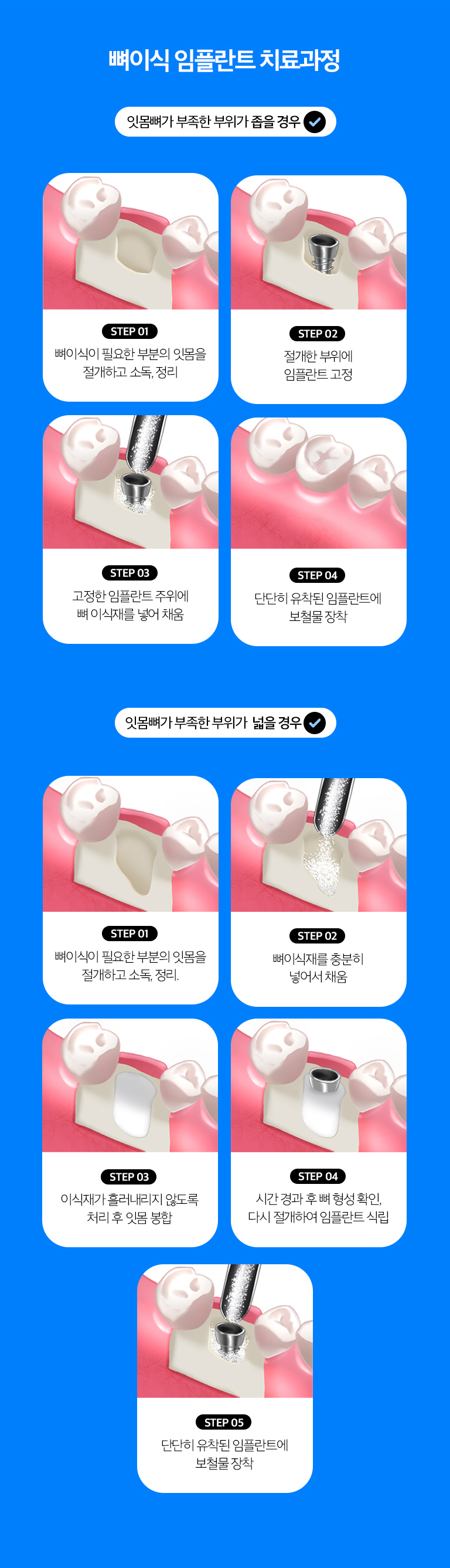 수원 뼈이식 임플란트 상세 안내 - 동시 뼈이식과 단계적 뼈이식 - 결손이 제한적이고 임플란트 초기 고정을 확보할 수 있으면 식립과 뼈이식을 함께 고려할 수 있습니다. 결손이 크거나 조직 상태가 불리하면 뼈이식 후 치유기간을 두고 임플란트를 진행할 수 있습니다.