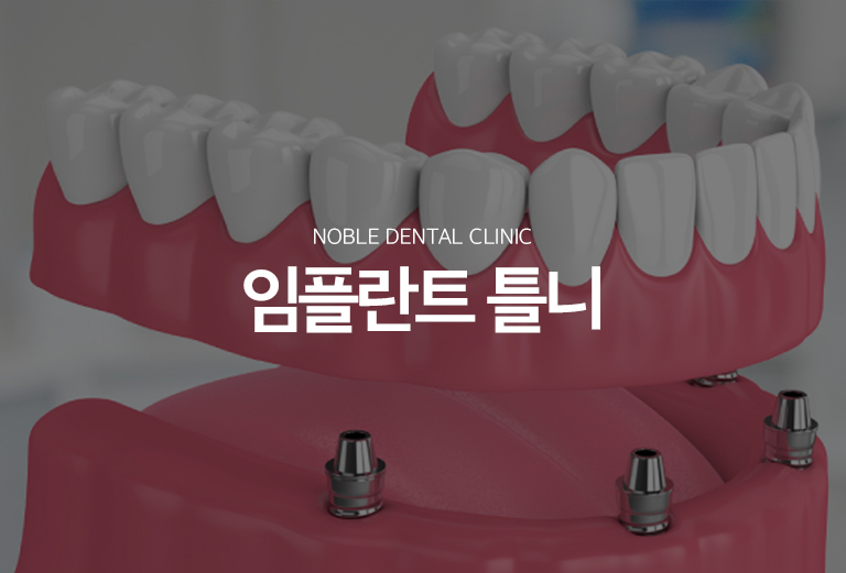 수원 임플란트 틀니 대표 안내 - 임플란트 틀니는 여러 치아가 상실된 경우 소수의 임플란트를 틀니의 지지와 유지에 활용하는 치료 방식입니다. 남아 있는 치아와 잇몸뼈, 현재 사용하는 틀니의 상태, 씹는 힘과 위생관리 능력을 함께 평가해 치료계획을 세웁니다.