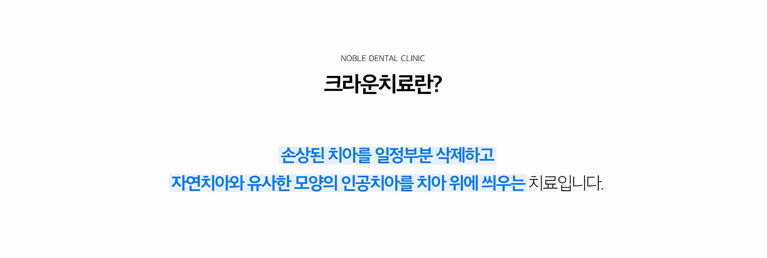 수원 크라운 치료 상세 안내 - 크라운이 필요한 경우 - 충치 범위가 넓어 단순 충전으로 지지하기 어려운 경우, 치아가 깨지거나 금이 간 경우, 신경치료로 치질이 약해진 경우, 기존 큰 보철을 교체해야 하는 경우에 고려합니다. / 남은 치아를 얼마나 보존할 수 있는지 확인합니다 - 충치와 파절선을 제거한 뒤 남는 건강한 치질, 치아 뿌리와 잇몸 상태, 교합력을 확인합니다. 뿌리까지 문제가 있는 경우에는 먼저 신경치료 또는 치주치료가 필요할 수 있습니다.