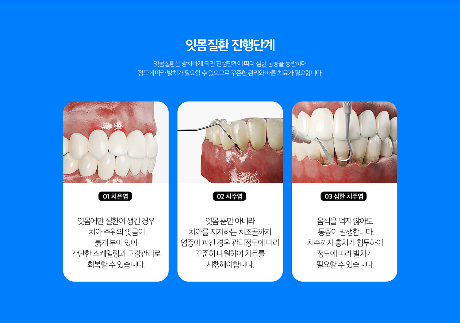 수원 치주치료 상세 안내 - 치료 단계 - 초기에는 스케일링과 위생관리로 염증 원인을 줄이고, 잇몸 아래 치석과 염증이 깊은 경우에는 치근면 관리나 추가적인 치주치료를 진행할 수 있습니다.