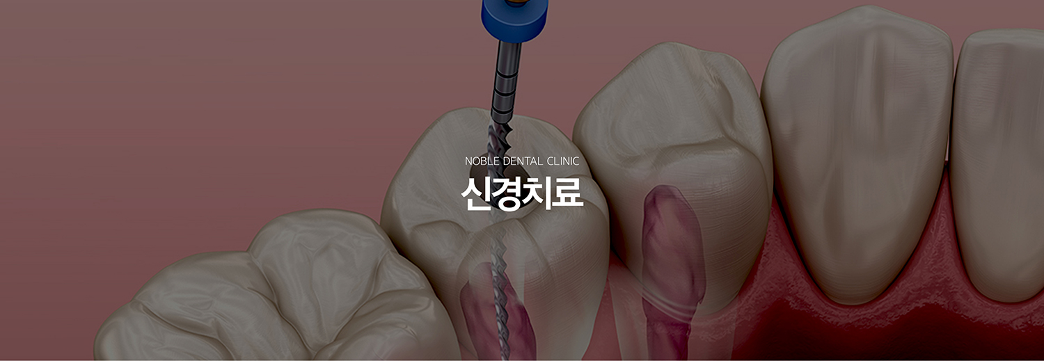 수원 신경치료 대표 안내 - 신경치료는 깊은 충치나 파절, 외상으로 치아 안의 치수가 회복하기 어렵게 염증 또는 괴사된 경우 감염된 조직을 제거하고 뿌리 내부를 세척·소독한 뒤 밀폐하는 치료입니다. 발치 전 자연치아를 보존하기 위해 검토하는 중요한 치료입니다.