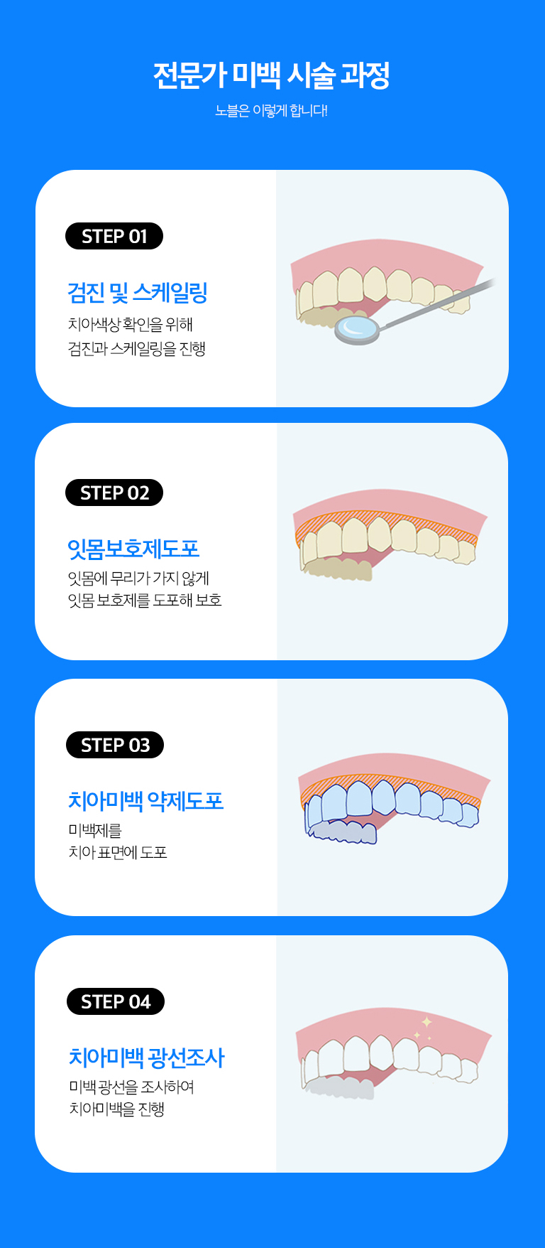 수원 치아미백 상세 안내 - 전문가 미백 - 치과에서 잇몸을 보호한 뒤 고농도 미백제를 사용해 진행할 수 있습니다. 필요한 횟수와 목표 색은 현재 치아 색과 민감도에 따라 조절합니다.